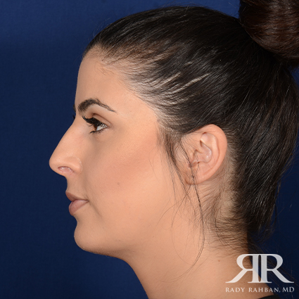 Chin Augmentation