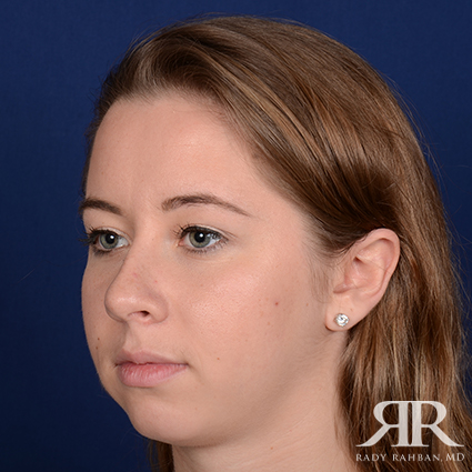 Chin Augmentation