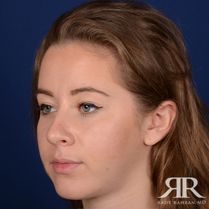 Chin Augmentation