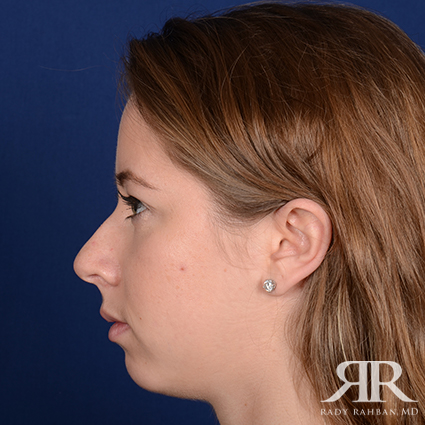 Chin Augmentation