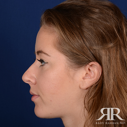 Chin Augmentation