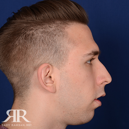 Chin Augmentation