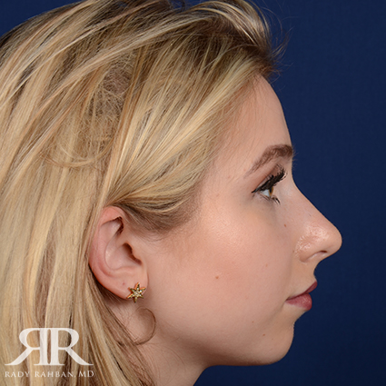 Chin Augmentation