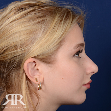 Chin Augmentation