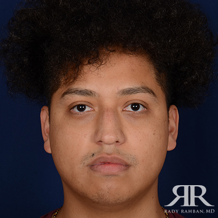 Male Rhinoplasty