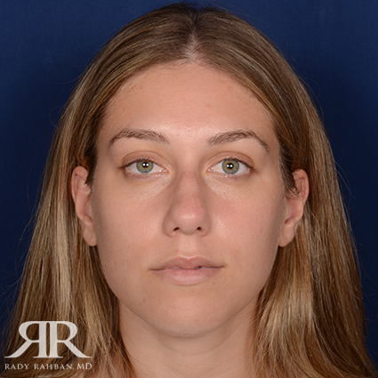 Rhinoplasty w/ Chin Implant