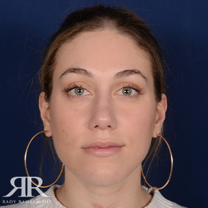 Rhinoplasty w/ Chin Implant