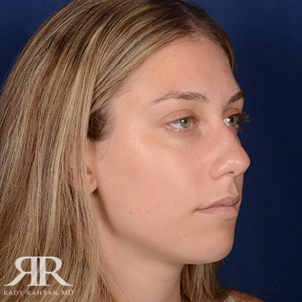 Female Rhinoplasty