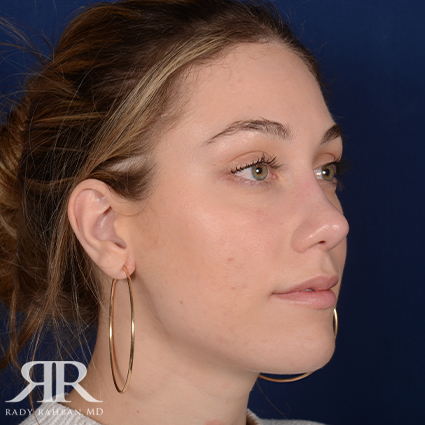 Rhinoplasty w/ Chin Implant