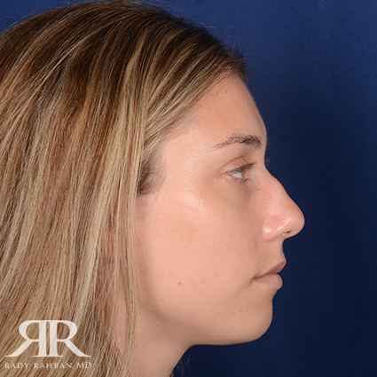 Rhinoplasty w/ Chin Implant