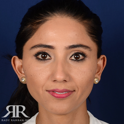 Female Rhinoplasty