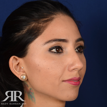 Female Rhinoplasty