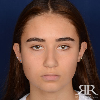 Female Rhinoplasty