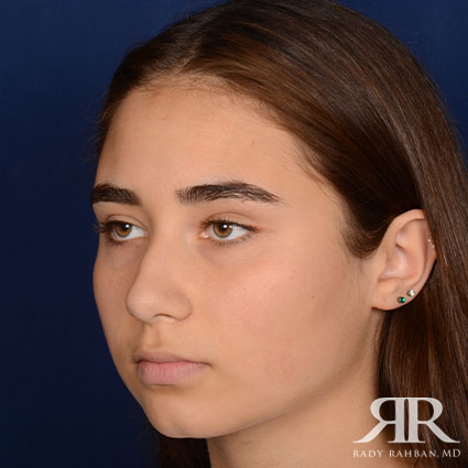 Female Rhinoplasty