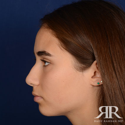 Female Rhinoplasty