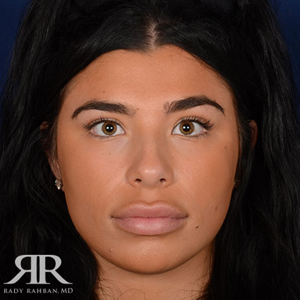 Female Rhinoplasty