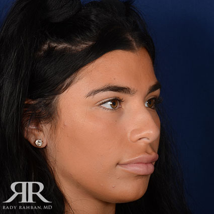 Female Rhinoplasty