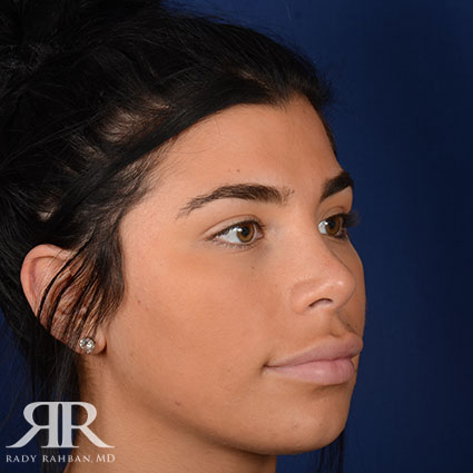 Female Rhinoplasty