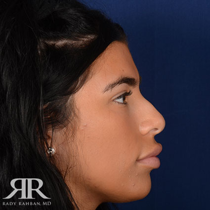 Female Rhinoplasty