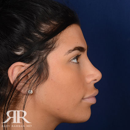 Female Rhinoplasty