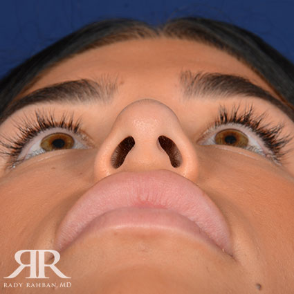 Female Rhinoplasty