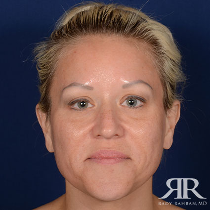 Female Rhinoplasty