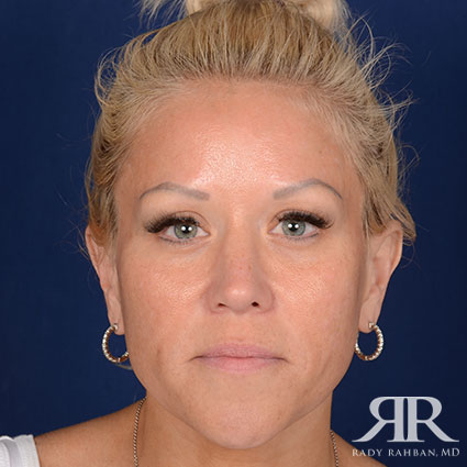 Female Rhinoplasty