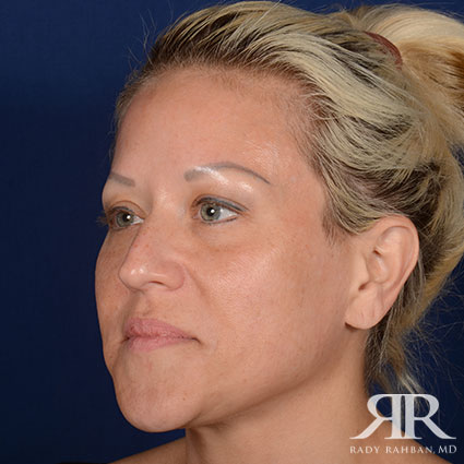 Female Rhinoplasty