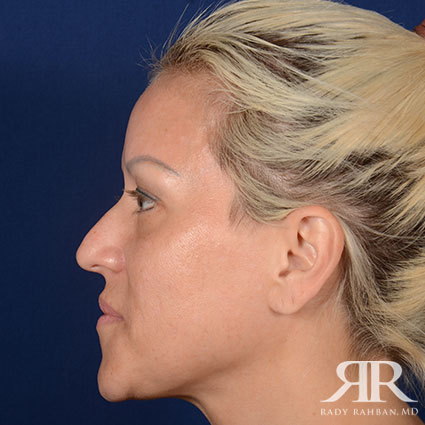 Female Rhinoplasty