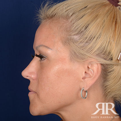 Female Rhinoplasty