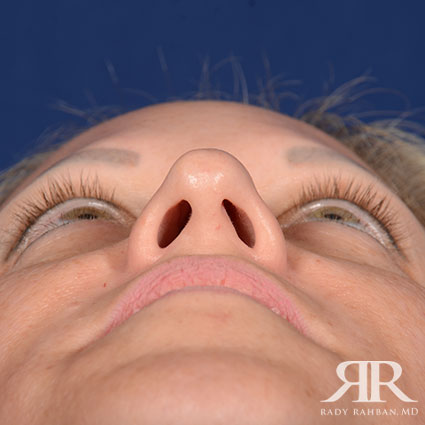 Female Rhinoplasty