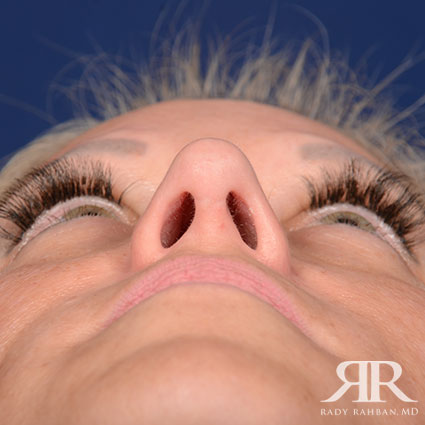 Female Rhinoplasty