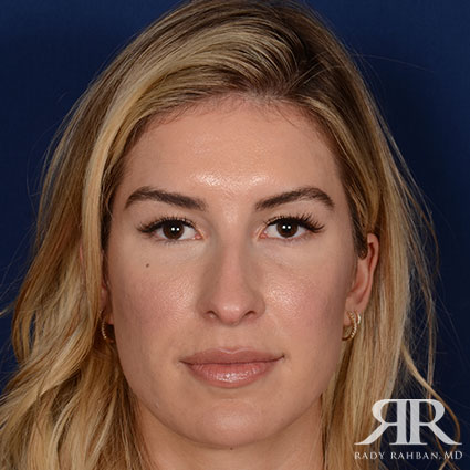 Female Rhinoplasty