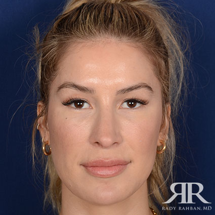 Female Rhinoplasty