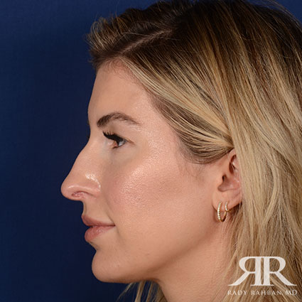 Female Rhinoplasty