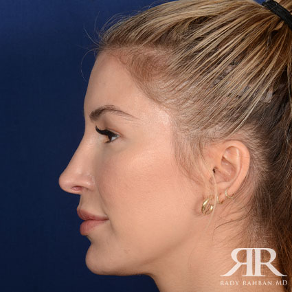 Female Rhinoplasty