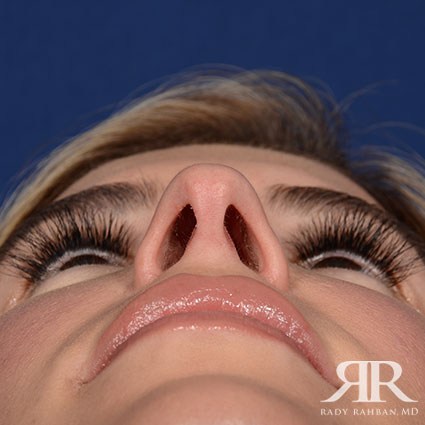 Female Rhinoplasty