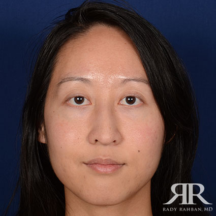 Female Rhinoplasty