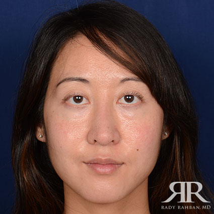 Female Rhinoplasty