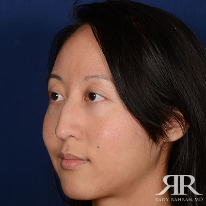 Female Rhinoplasty