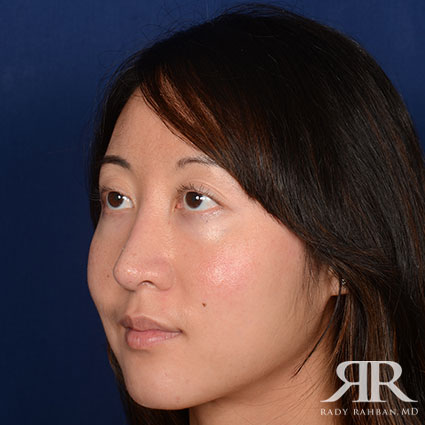 Female Rhinoplasty