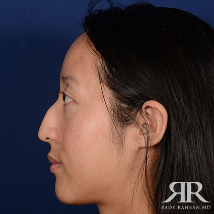 Female Rhinoplasty