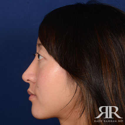 Female Rhinoplasty