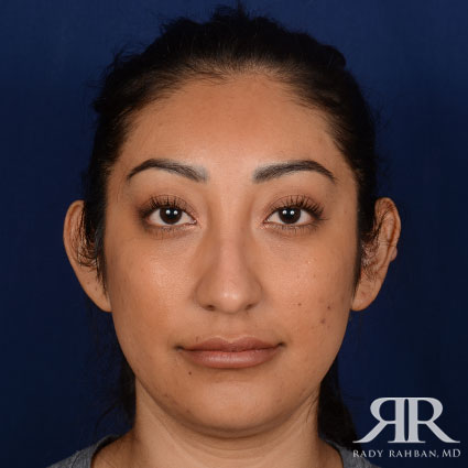 Female Rhinoplasty