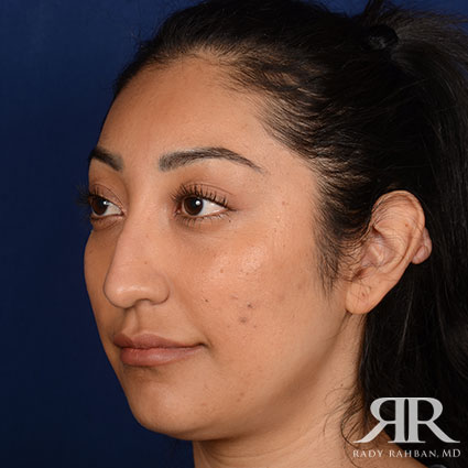 Female Rhinoplasty