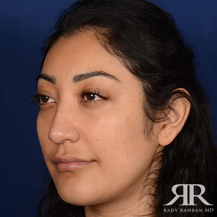 Female Rhinoplasty