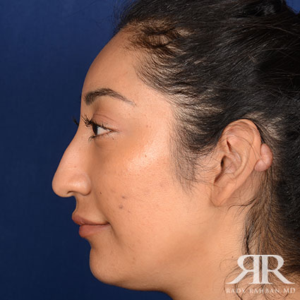 Female Rhinoplasty