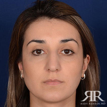 Female Rhinoplasty