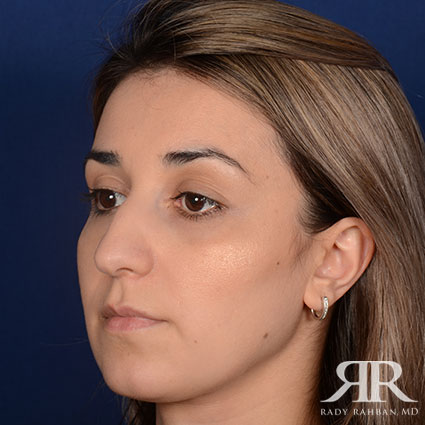 Female Rhinoplasty