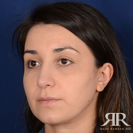 Female Rhinoplasty